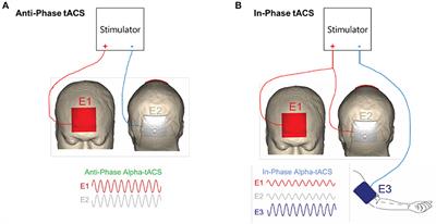 Remotely Monitored Home-Based Neuromodulation With Transcranial Alternating Current Stimulation (tACS) for Mal de Débarquement Syndrome